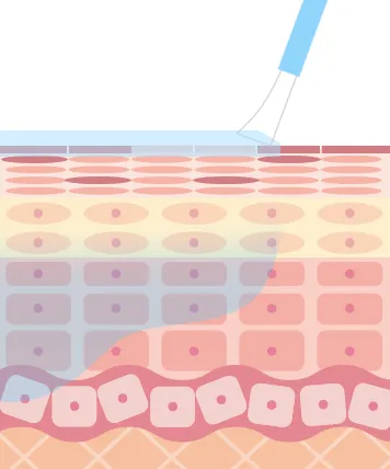 ピーリング剤が皮膚の角質層に作用し、ニキビやシミの原因である古い角質や毛穴の詰まりを柔らかくして剥がれやすくします。