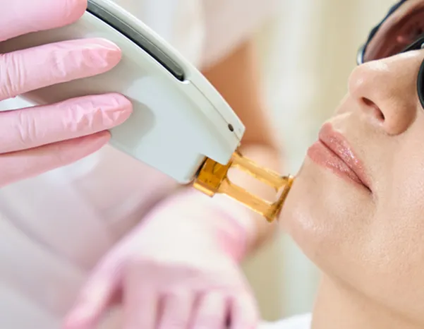 レーザーフェイシャル