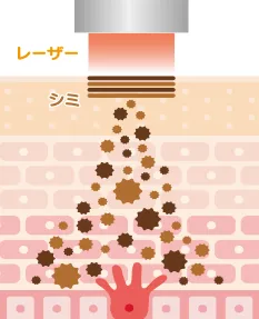 レーザーがメラニン色素に反応