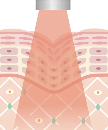 ヤグレーザーは波長が長いため、表皮にダメージを与えずに皮膚の真皮層に熱を加えコラーゲンに働きかけるレーザー