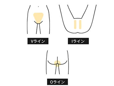 VIO都度払い11,860円(税込)