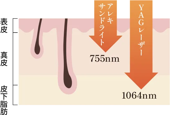 アレキサンドライトレーザーとYAGレーザーについて