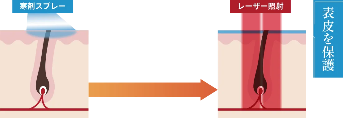 レーザー照射直前に寒剤をスプレーし、表皮を保護