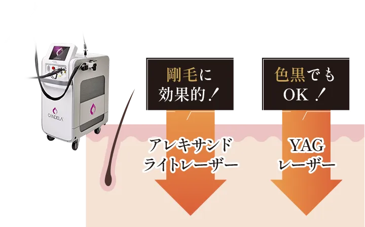 剛毛に効果的なアレキサンドライトレーザー・色黒でもOKなYAGレーザー
